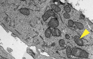 lung carcinoma cell